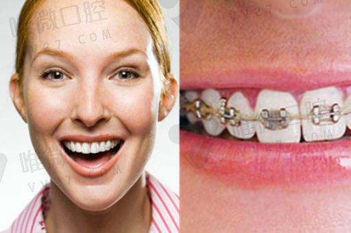 什么叫做种植牙转移（种植牙戴牙流程）(图1)